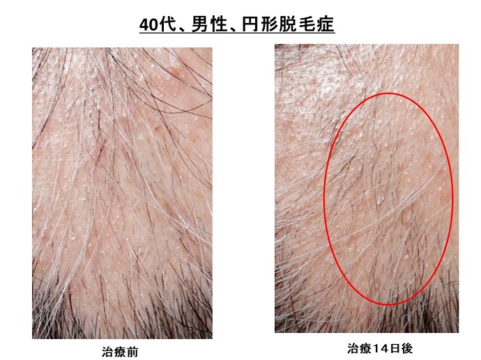 円形脱毛症　病院